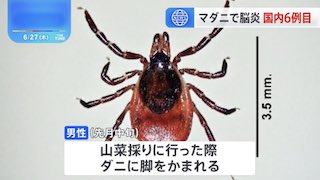 Image of 札幌男子因蜱虫叮咬感染脑炎